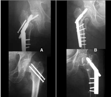 Osteoporotic Fracture Fixation Failure A Femoral Neck Fractures B