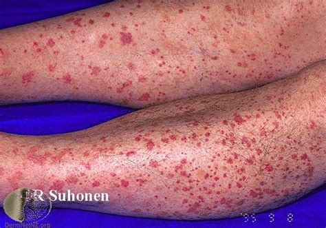 What Causes Red Bumps On Your Legs