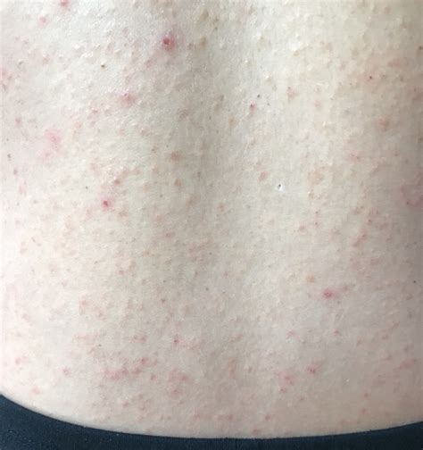 My Personal Story Of Allergic Contact Dermatitis Diagnosis And