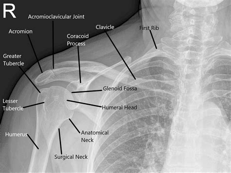 Artroscopia Articulación Del Hombro Complete Orthopedics Multiple