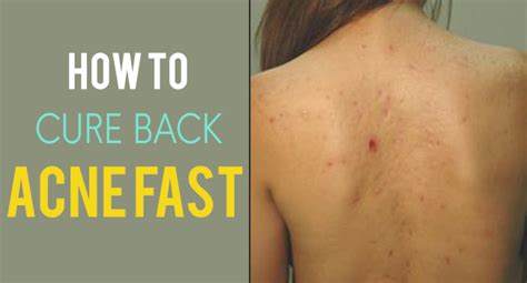 How To Cure Back Acne Fast Remedies Lore