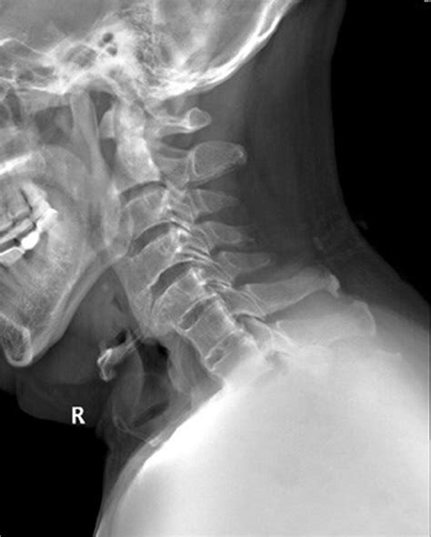 The Lateral Radiograph Of Cervical Spine Shows Characteristic Flowing