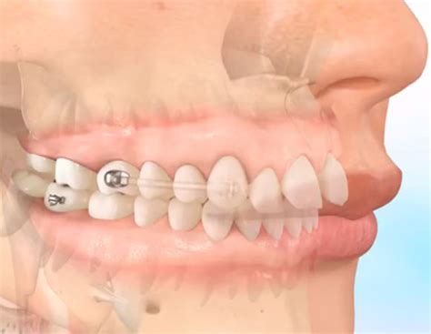 Carriere Motion Appliance Orthodontic Treatment Winchester Gg Orthodontics
