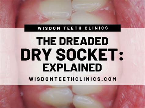 Dreaded Dry Socket Explained — Wisdom Teeth Clinics