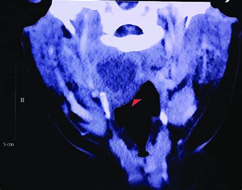Contrast Enhanced Computed Tomography Neck Scan Axial View Oblong