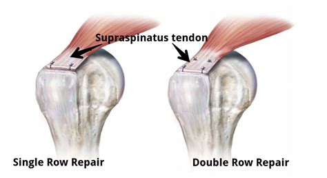 Is Early Physical Therapy Safe After A Rotator Cuff Repair