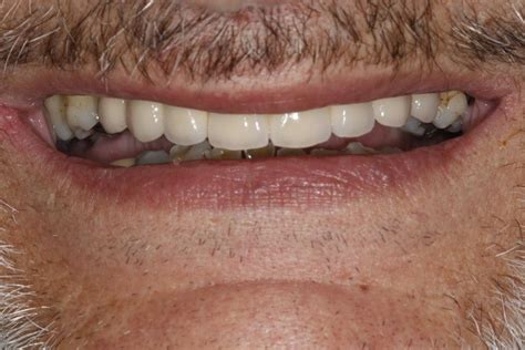 Before And After Dental Implants Dentist In Kent