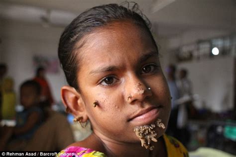 Bangladesh Treats First Case Of Tree Girl Syndrome Daily Mail Online
