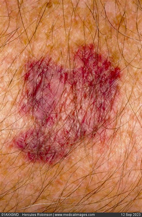 Stock Image Dermatology Senile Purpura A Dark Red Patch On The Back Of