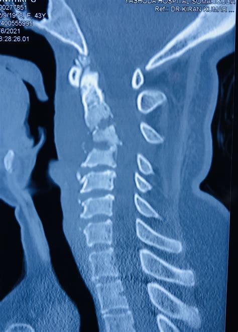 Cervical Spine Tuberculosis With Quadriparesis Complex Cervical Spine