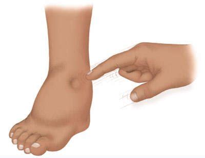 Zašto otiču noge i ruke i koji su uzroci, kako lečiti vodu u kolenu : Narodni lek
