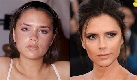 Before And After Plastic Surgery Stunning Transformations