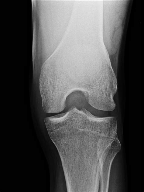 Patellar avulsion fracture | Image | Radiopaedia.org
