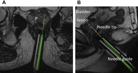 Mr Imagingguided Prostate Biopsy Techniques Magnetic Resonance