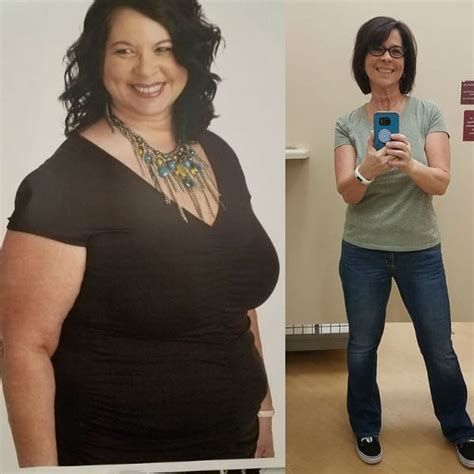 Captivating Weight Loss Surgery Before And After Sleeve Best