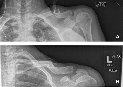 Figure 1 from Midshaft clavicle fractures in adults ...
