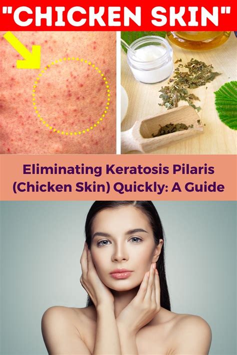 Eliminating Keratosis Pilaris Chicken Skin Quickly A Guide In 2023