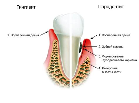 Periodontitis Signs Causes Diagnosis And Treatment Methods
