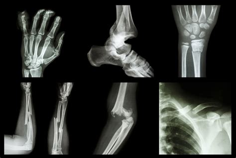 How To Know If A Bone Is Broken Elitecare Emergency Hospital