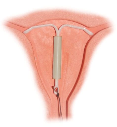 Iuds And Female Condoms Woman Power Ms Magazine