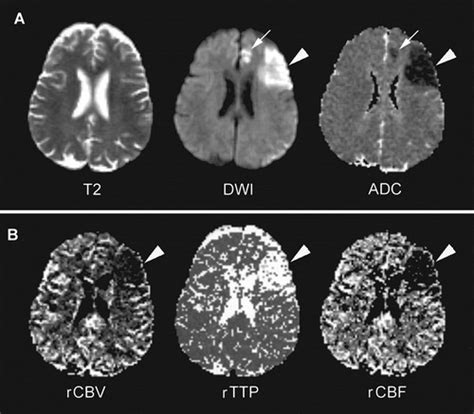Intra Arterial Rtpa Treatment Of Stroke Assessed By Diffusion And