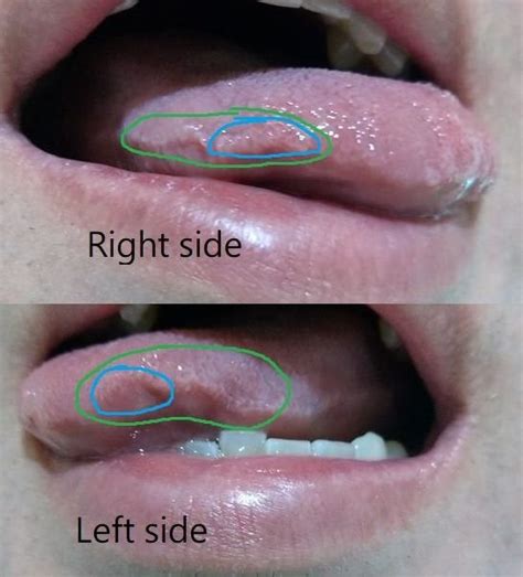Learn vocabulary, terms and more with flashcards, games and other only rub 220.84/month. Is this normal? Tongue (pic included) : HPV