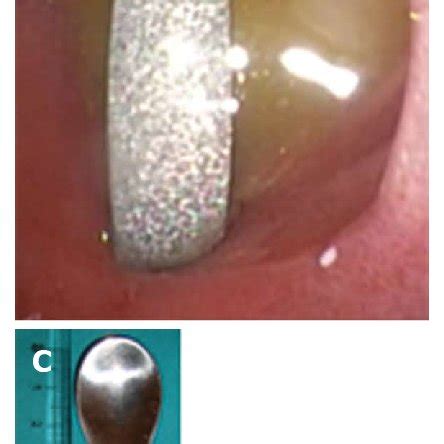 Endoscopic Retrieval Of A Duodenal Perforating Teaspoon A Plain