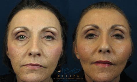 Lower Eyelid Blepharoplasty Before After Photo Gallery Vancouver My