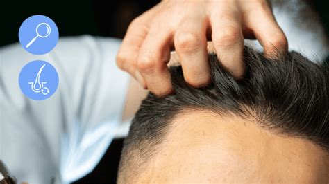 6 Accurate Signs Of Balding How To Tell If Youre Going Bald