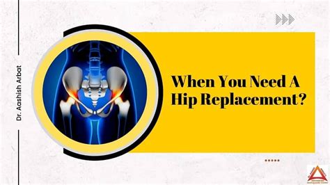 When You Need A Hip Replacement Hip Replacement Recovery Time Best Joint Replacement