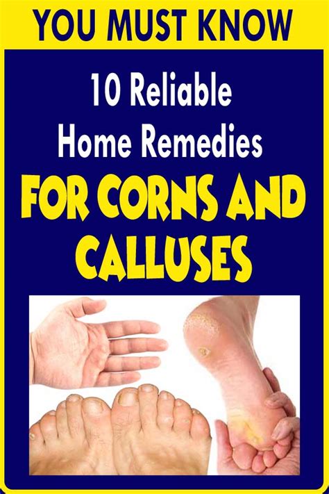 10 Reliable Home Remedies For Corns And Calluses
