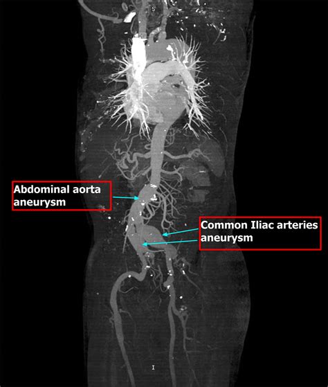 Iliac Artery Common Iliac Artery Internal And External Iliac Artery