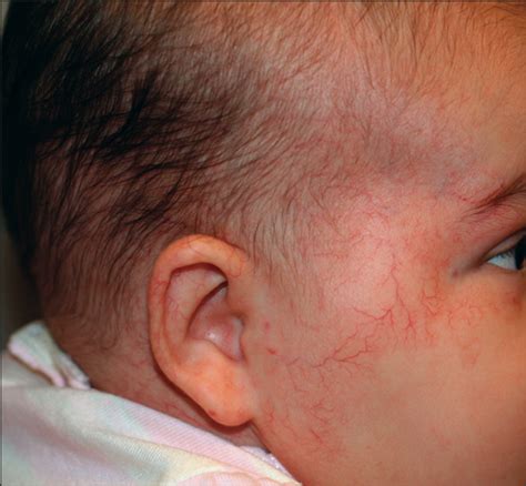 Clinical Spectrum And Risk Of Phace Syndrome In Cutaneous And Airway