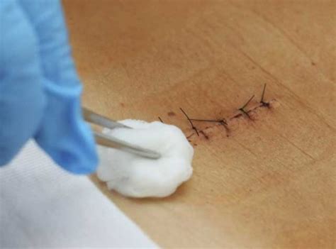 Sutures And Surgical Wounds How To Care For Them Properly