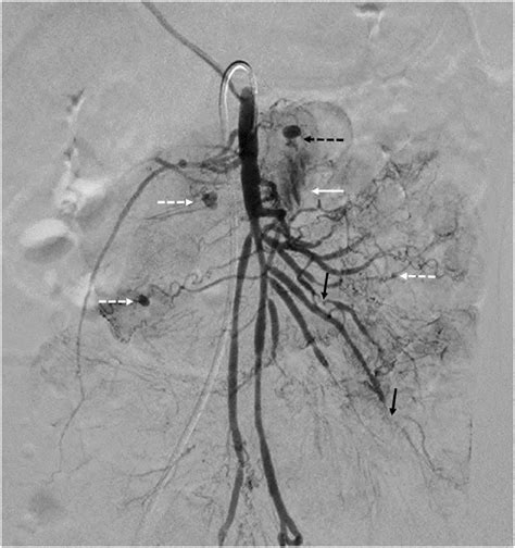 Superior Mesenteric Artery Angiogram