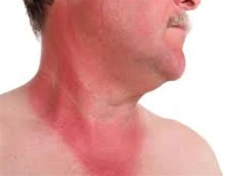 Sun Poisoning On Face How To Treat Swollen Blisters From Sun