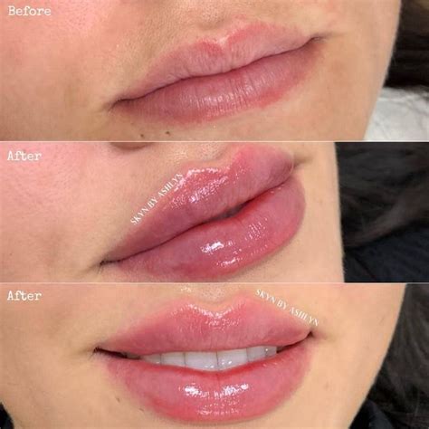 Best Of Cosmetic Dermatology On Instagram Beforeafter Lip Filler 😍
