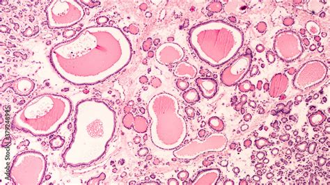 Photomicrograph Showing Histology Of A Benign Thyroid Nodule In A The