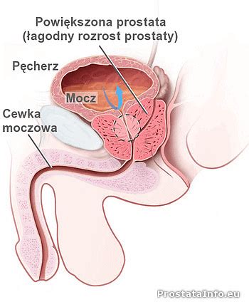 Co to jest i jak leczyć przerost prostaty MedoVita pl