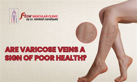 Are Varicose Veins A Sign Of Poor Health Dr Abhilash