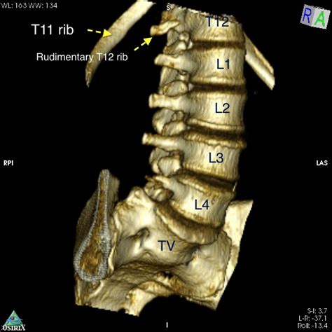 Sacralization Of L5 Radiology Case