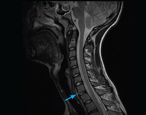 Adult Mri Series Cervical Spine Trauma