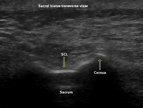 Ultrasound Guidance For Caudal Epidural Steroid Injection