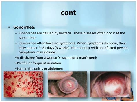 Different Between Syphilis Gonorrhea