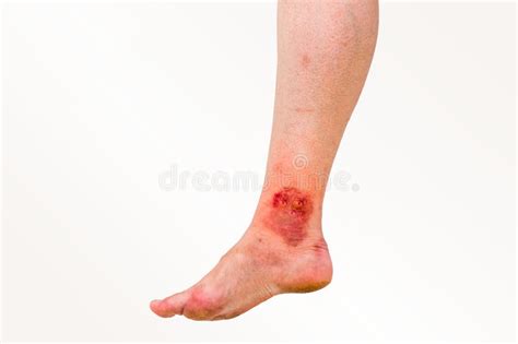 Red Rash On Leg Of Patient Who Was Bitten By An Insect Stock Photo