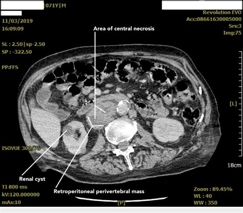 Abdominopelvic Ct Scan With Contrast Shows Retroperitoneal Masses