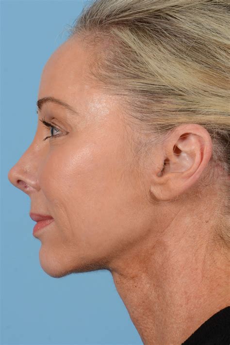 Before And After Neck Lift And Laser Skin Resurfacing And Brow Lift