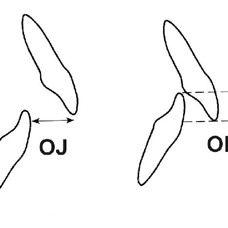 Relationship Of Incisors OJ Overjet Sagittal Overlap OB