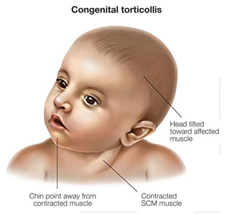 What Is Torticollis And Its Treatment Cranial Therapy