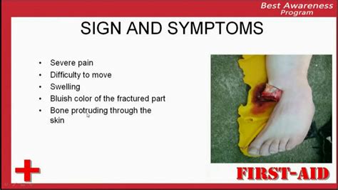 Sign And Symptoms Of Fracture Identification Of Fracture Clinical